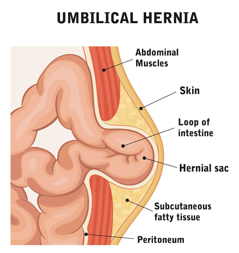 Ernia ombelicale