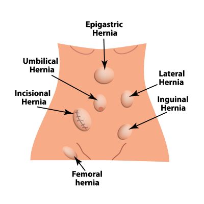 Ernia epigastrica